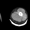 SPORK, NICO - 22.03.1976 - 02.08.2022 - CT obere Extremität - 17:56:57